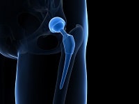 Hip Replacement In India