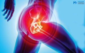 Read more about the article Know all about Partial Hip Replacement in India￼