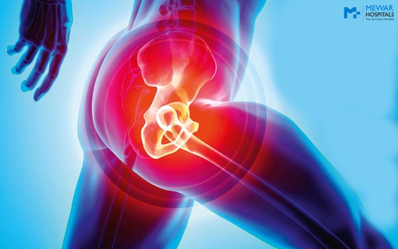You are currently viewing Know all about Partial Hip Replacement in India￼
