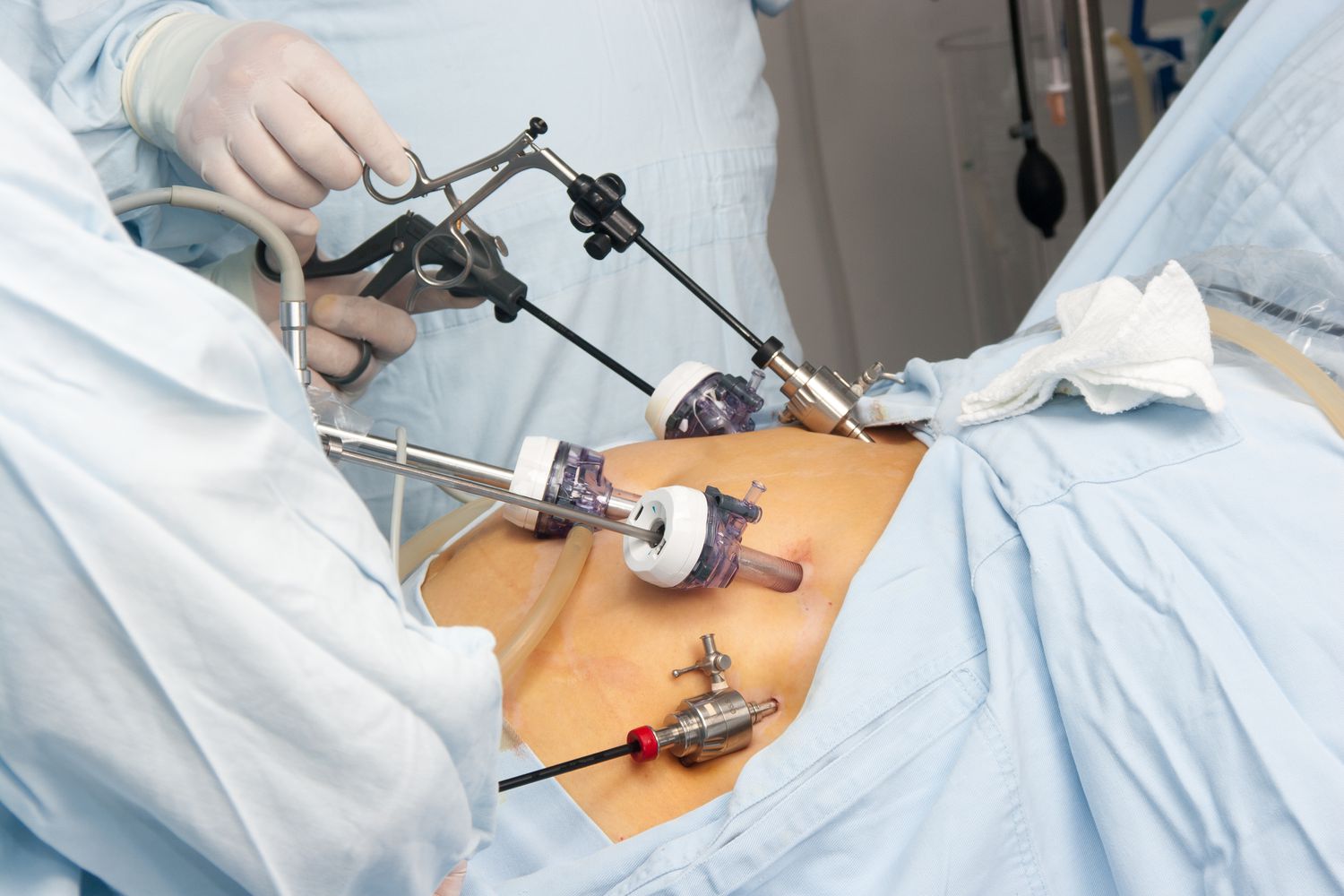 You are currently viewing Obesity: What Is Bariatric Surgery And When To Have The Surgery