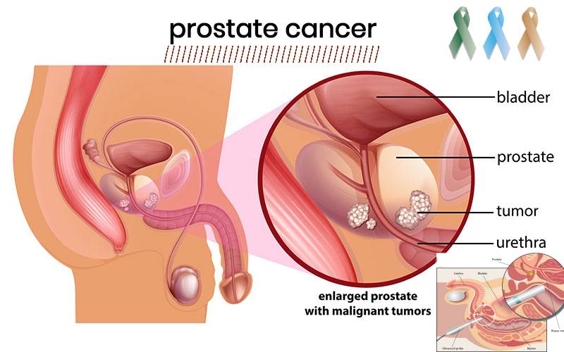 You are currently viewing Prostate Cancer: Causes, Symptoms, and Treatments.